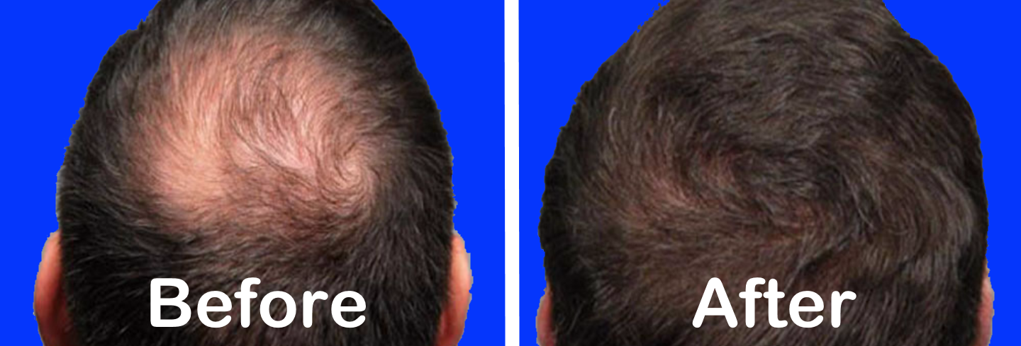 PAINLESS PLASMA TREATMENT FOR HAIR LOSS - QUEENS & LONG ISLAND, NY - Alla  Brouk MD PRP Hair Loss & ED NY & NJ