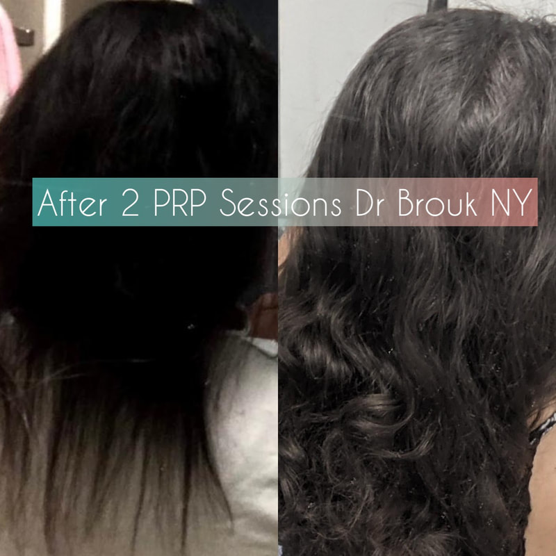 Articles - Alla Brouk MD PRP Hair Loss & ED NY & NJ