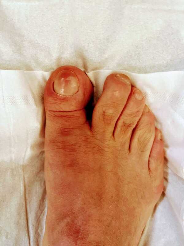 Acute Gout