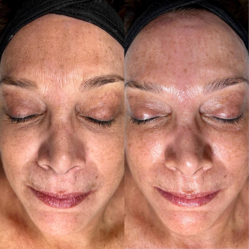 HydraFacial Before and After 