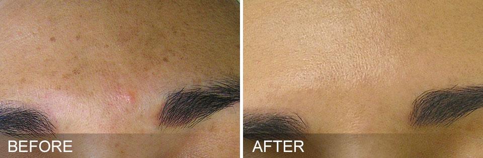 HydraFacial Forehead Before and After Treatment Results