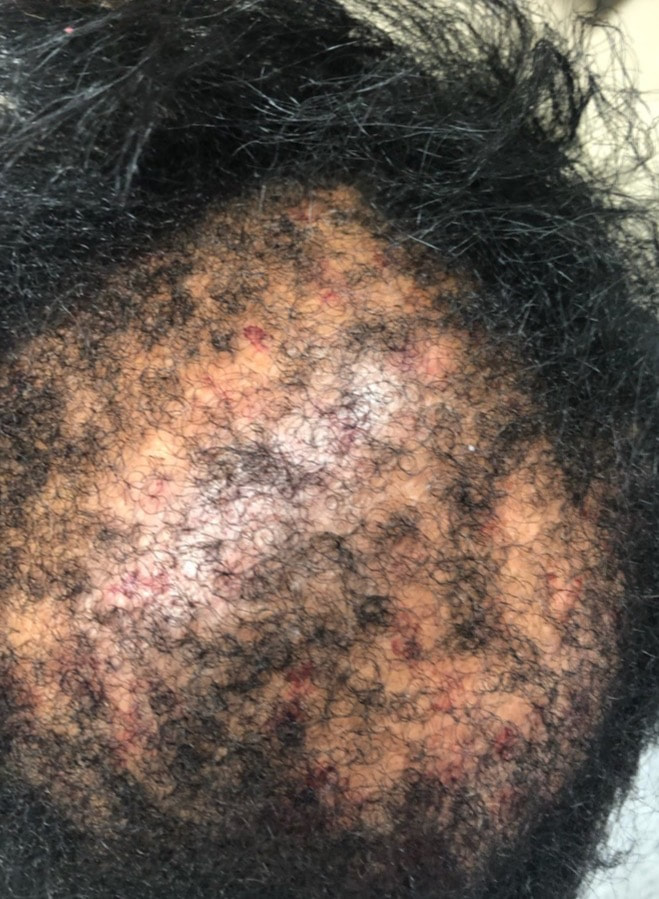 Severe Hair Loss Four PRP and One Amnion Treatments  Before & After 