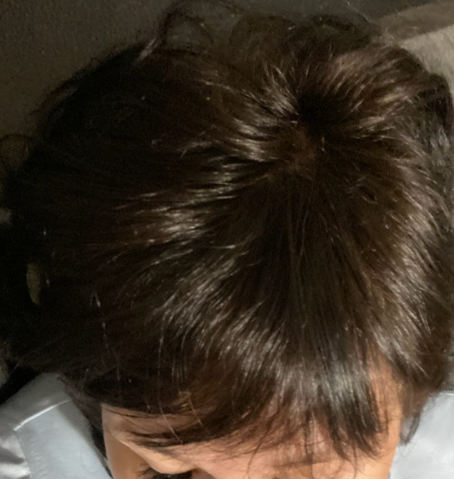OUR PAINLESS HAIR LOSS MICROGRAFTING TREATMENT RESULTS - Alla Brouk MD PRP  Hair Loss & ED NY & NJ