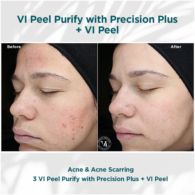 VI PEEL FOR ACNE AND ACNE SCARS
